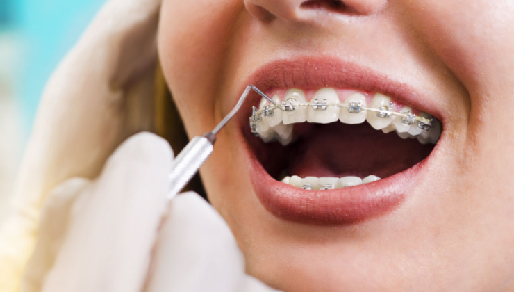 Ortodonti Tedavisinde Stom Dental Centre Farkı