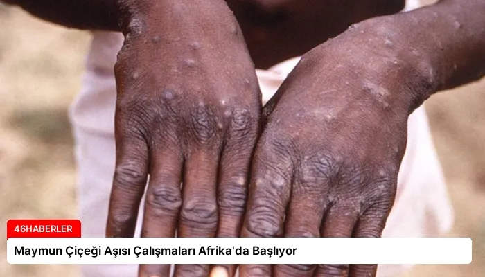 Maymun Çiçeği Aşısı Çalışmaları Afrika’da Başlıyor