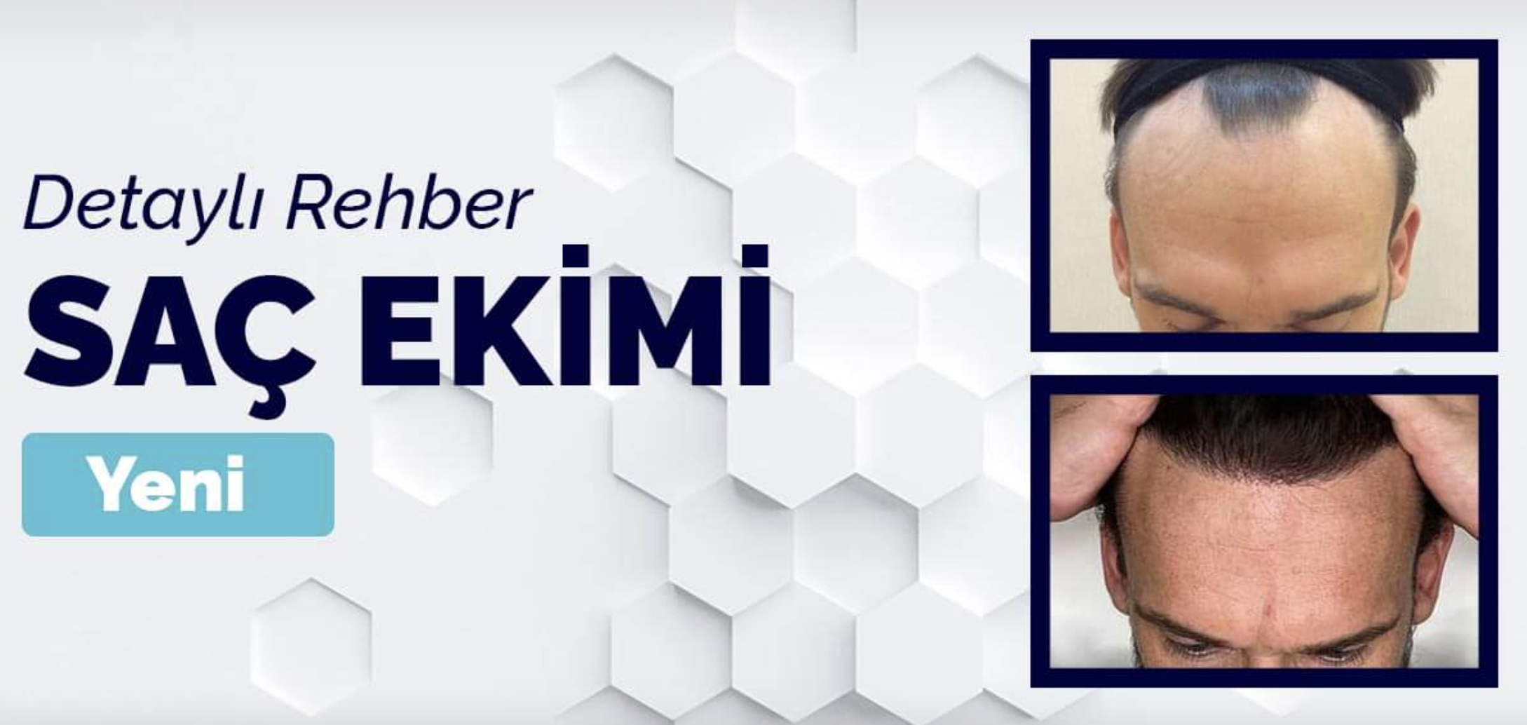 DHI Saç Ekimi Nedir? Yapılması Gerekli Midir?